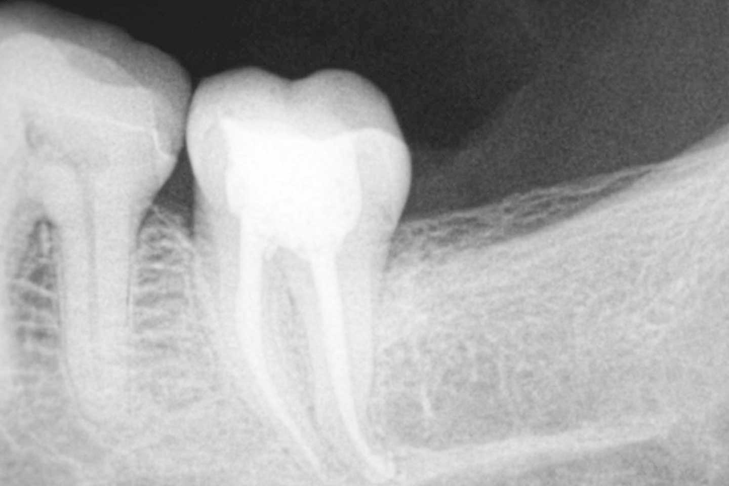 endodoncia