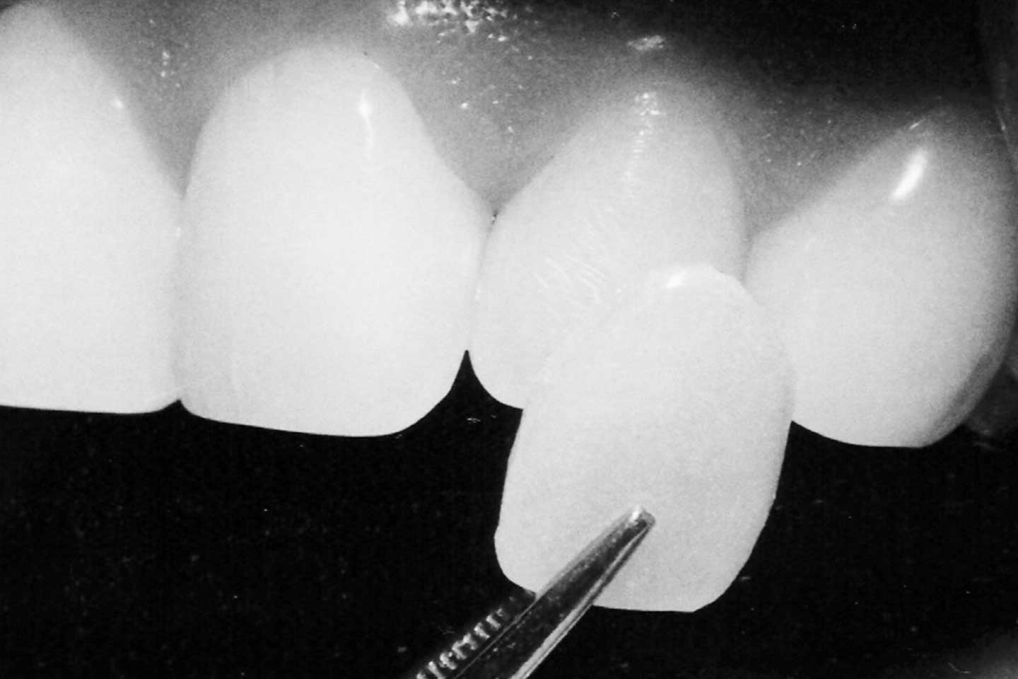 Carillas de ceramica