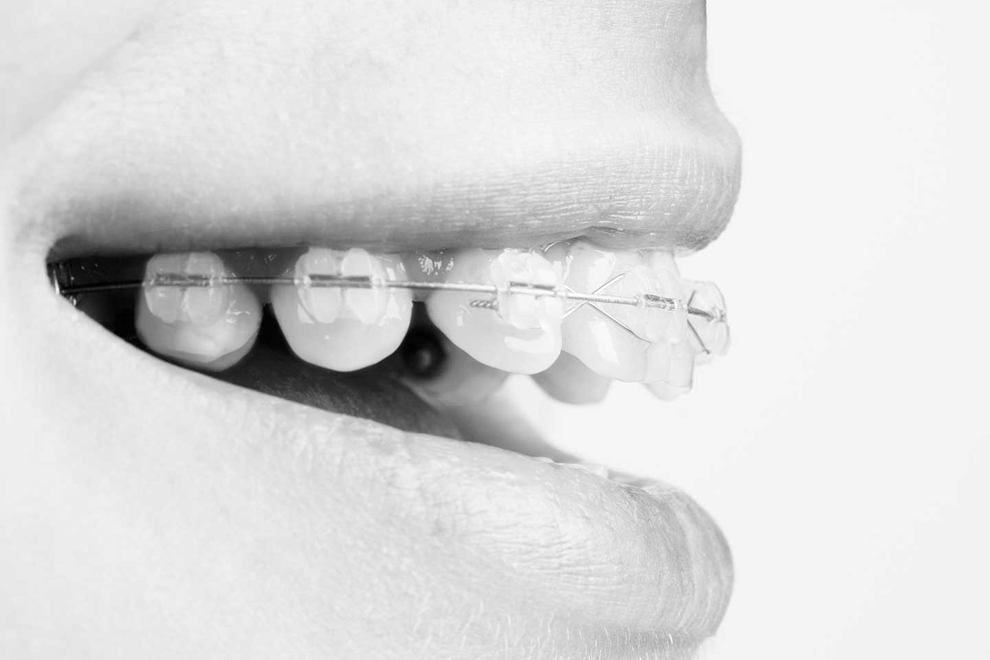 ortodoncia en adultos