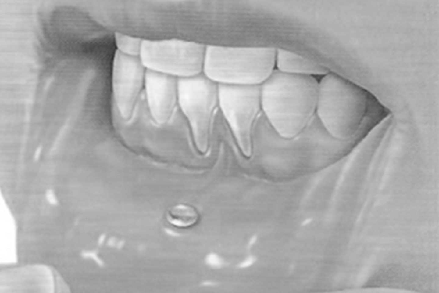 Restitucion encia perdida